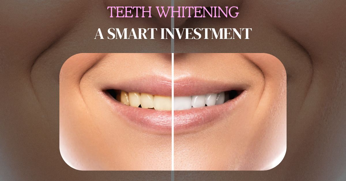 Is Professional Teeth Whitening a Smart Investment